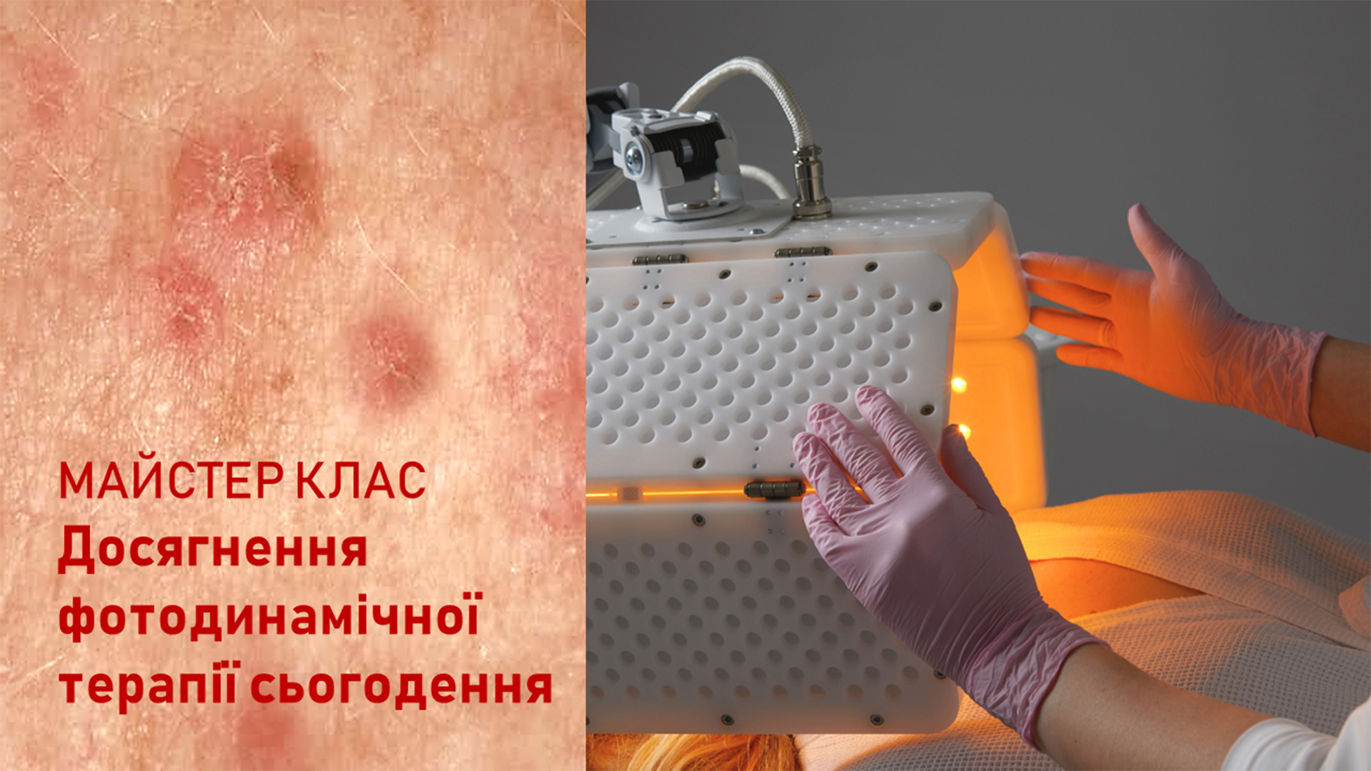 ДОСЯГНЕННЯ ФОТОДИНАМІЧНОЇ ТЕРАПІЇ СЬОГОДЕННЯ